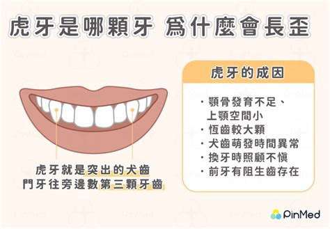 有虎牙好嗎|虎牙需要矯正嗎？不處理居然會造成嚴重口腔隱患